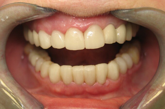Результаты реставрации зубов ПОСЛЕ