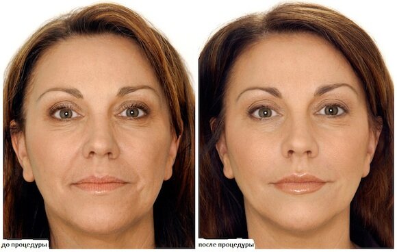 Химический пилинг лица: до и после процедуры.