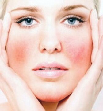 Раздражения на лице свойственны людям с чувствительной кожей.