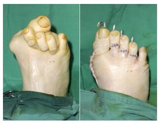 Хирургическое лечение вальгусной деформации стопы