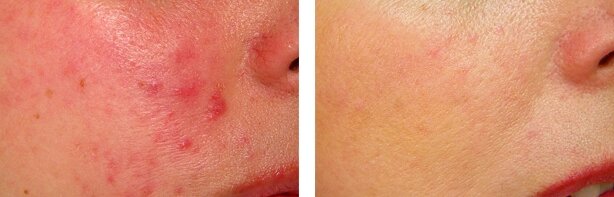 Фото до и после лечения купероза на лице с помощью косметических масок