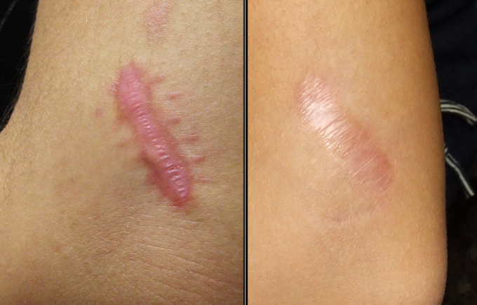 Коллоидный рубец: фото до и после лечения гормональными препаратами