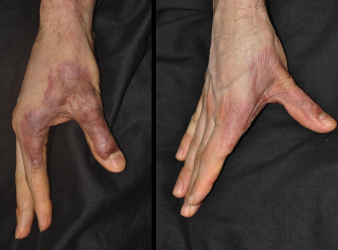 Коллоидный рубец: фото до и после лечения мазью