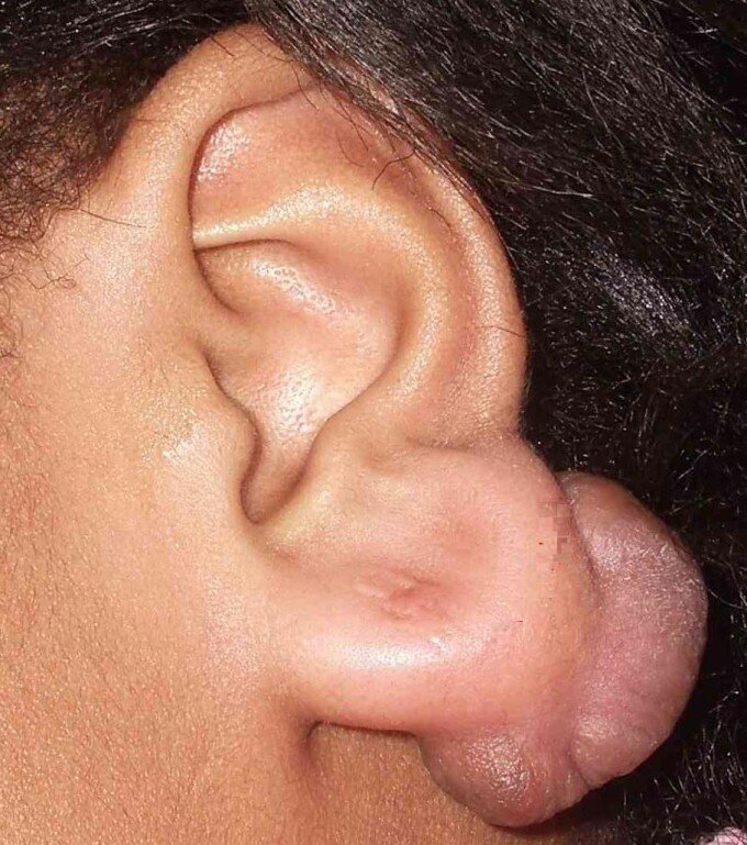 Коллоидные рубцы на ушах