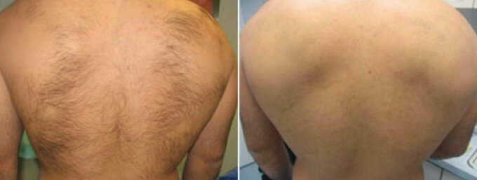 Шугаринг фото до и после эпиляции спины