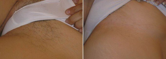 Шугаринг фото до и после эпиляции бикини