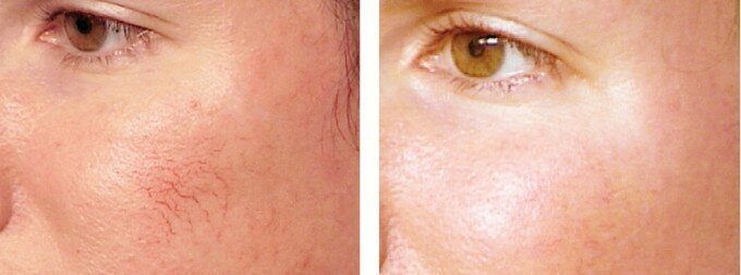 Фото до и после применения лазерной коррекции для лечения купероза на лице