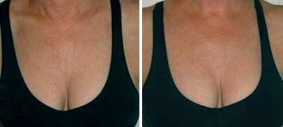 Фото до и после использования крема Evinal (Эвиналь) для увеличения груди