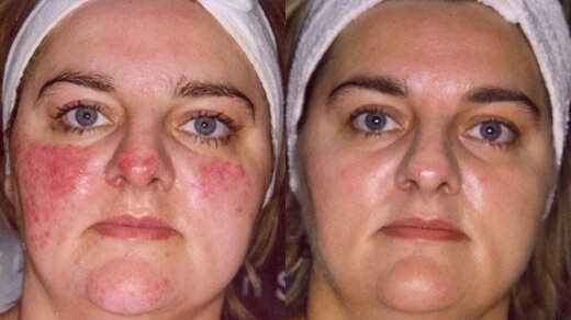 Фото до и после лечения купероза с помощью фототерапии