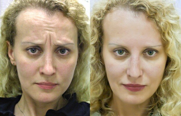 Фото до и после введения уколов ботокса в лобпациентке старше 35 лет