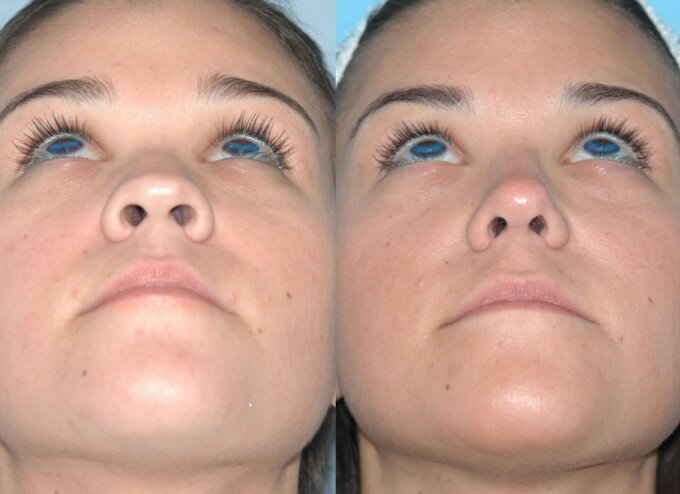 Ринопластика кончика носа: фото до и после