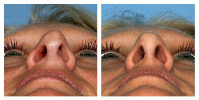 Фото до и после ринопластики кончика носа