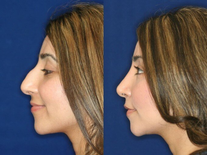 Ринопластика носа: фото до и после удаления горбинки
