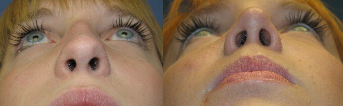 Фото до и после ринопластики ноздрей
