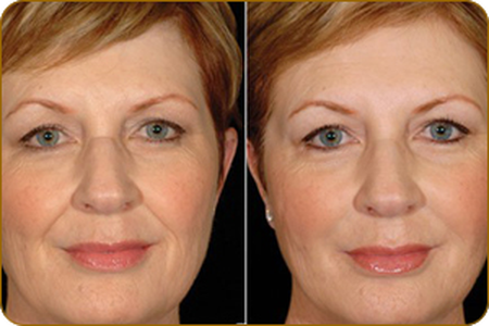 Фото до и после введения уколов ботокса в лоб и под глаза пациентке старше 50 лет