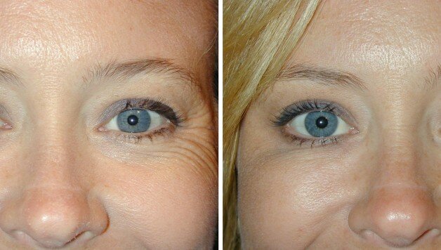 Фото до и после введения уколов ботокса в лоб и под глаза молодой пациентке