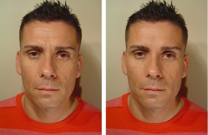Инъекции ботокса фото мужчины до и после