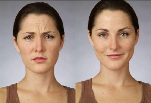 Фото до и после введения уколов ботокса в лоб