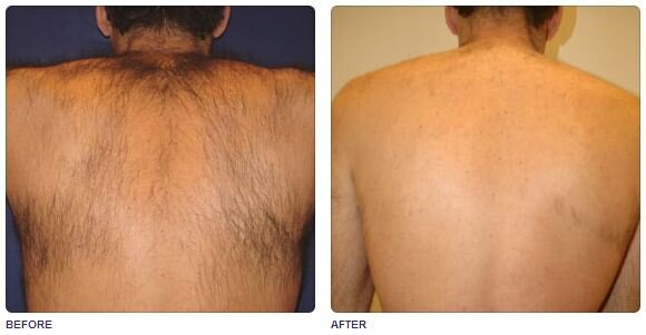 Фото до и после фотоэпиляции волос на спине