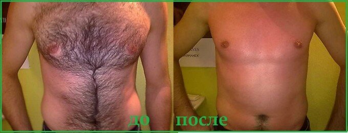 Фото до и после лазерной эпиляции на груди