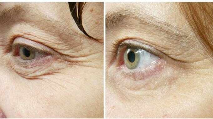 Массаж от морщин в области глаз, фото до и после