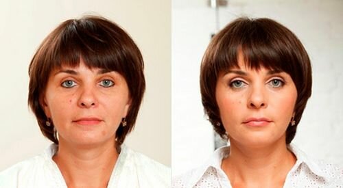 Фото до и после использования геля Перфекта Дерм