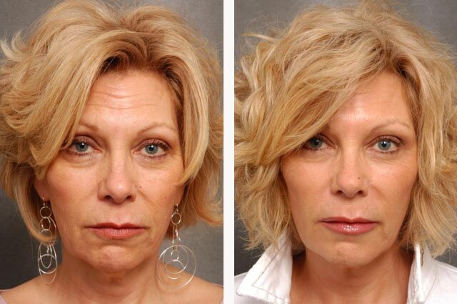 Фото до и после введения уколов ботокса в лоб пациентке 55 лет