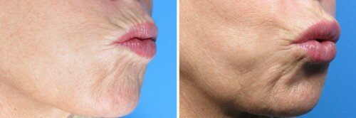 Вид губ в профиль после ботокса