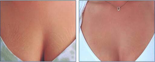 Фото: до и после механической микрошлифовки кожи