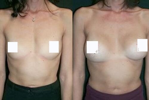 Увеличение груди гиалуроновой кислотой