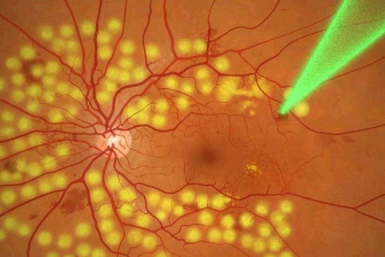 ретинопатия сетчатки при диабете — симптомы, лечение